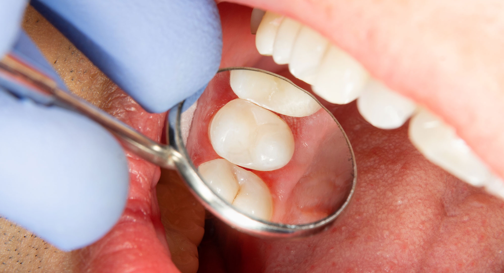 Eine Nahaufnahme eines Zahnarztes, der einen Zahnarztspiegel in den Mund eines Patienten hält, der während einer zahnärztlichen Untersuchung saubere weiße Zähne und Zahnfleisch reflektiert.