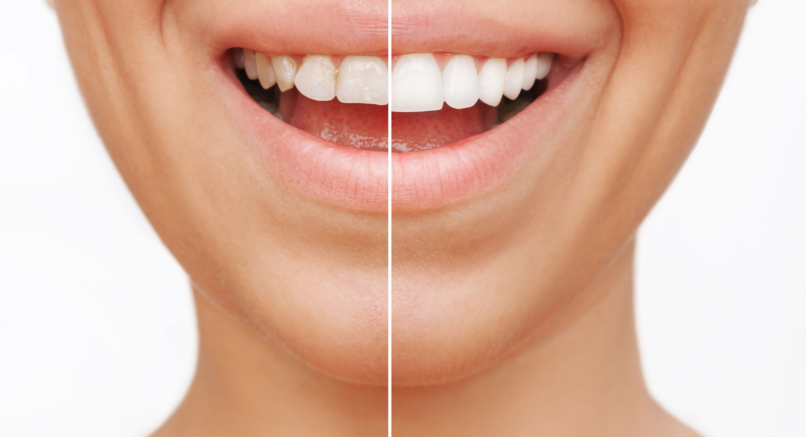 Eine Nahaufnahme eines lächelnden Mundes, wobei das Bild in der Mitte geteilt ist. Die linke Seite zeigt verfärbte, ungleichmäßige Zähne, während die rechte Seite gerade, weiße und saubere Zähne zeigt, was den Vorher-Nachher-Effekt der Zahnaufhellung verd