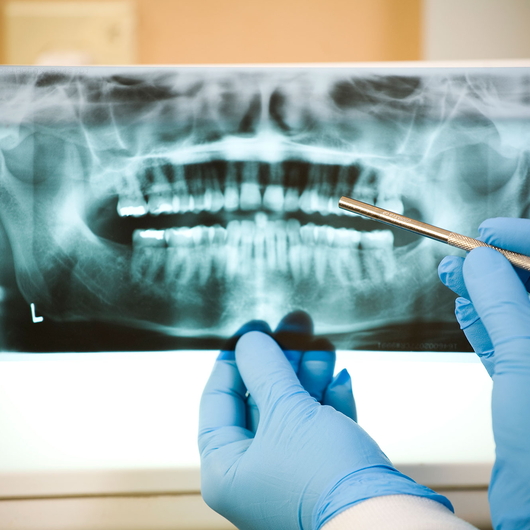 Eine Person mit blauen Handschuhen hält ein zahnärztliches Röntgenbild in der Hand, während eine andere behandschuhte Hand mit einem zahnärztlichen Werkzeug auf das Bild zeigt und dabei die Zähne und die Kieferstruktur hervorhebt.