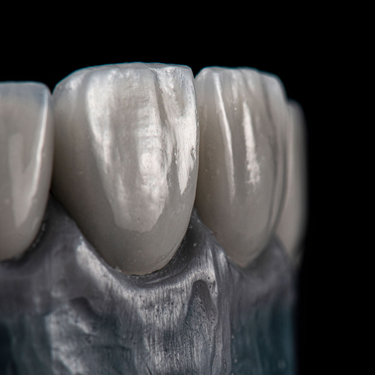 Emax Keramik Veneers B1 Farbe